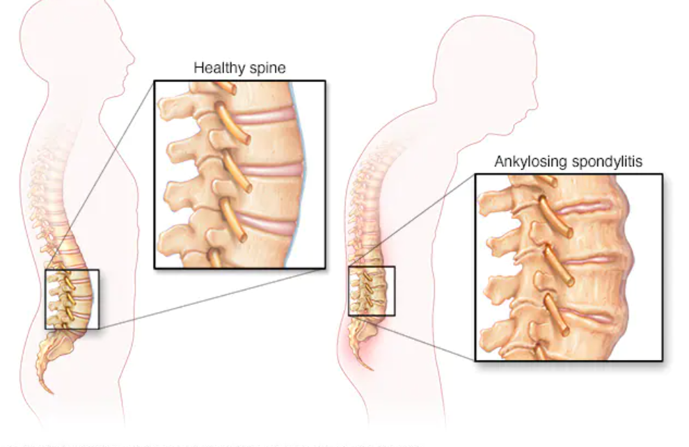 How to deal with Ankylosing Spondylitis？