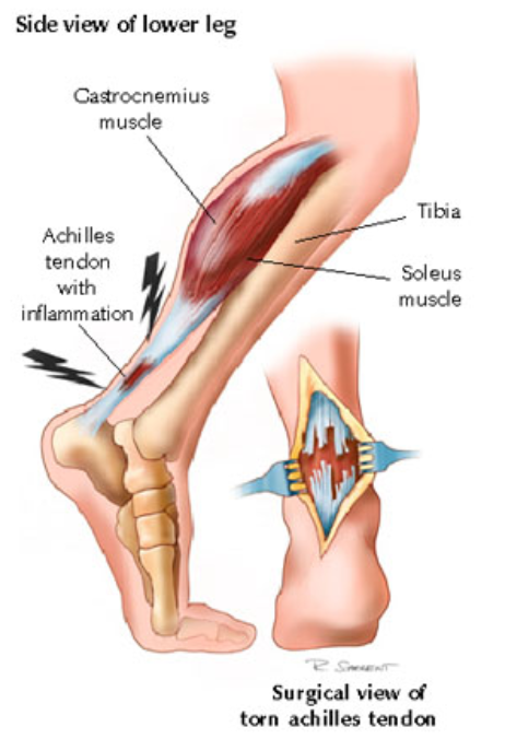 How to know if you take an Achilles muscle rupture？
